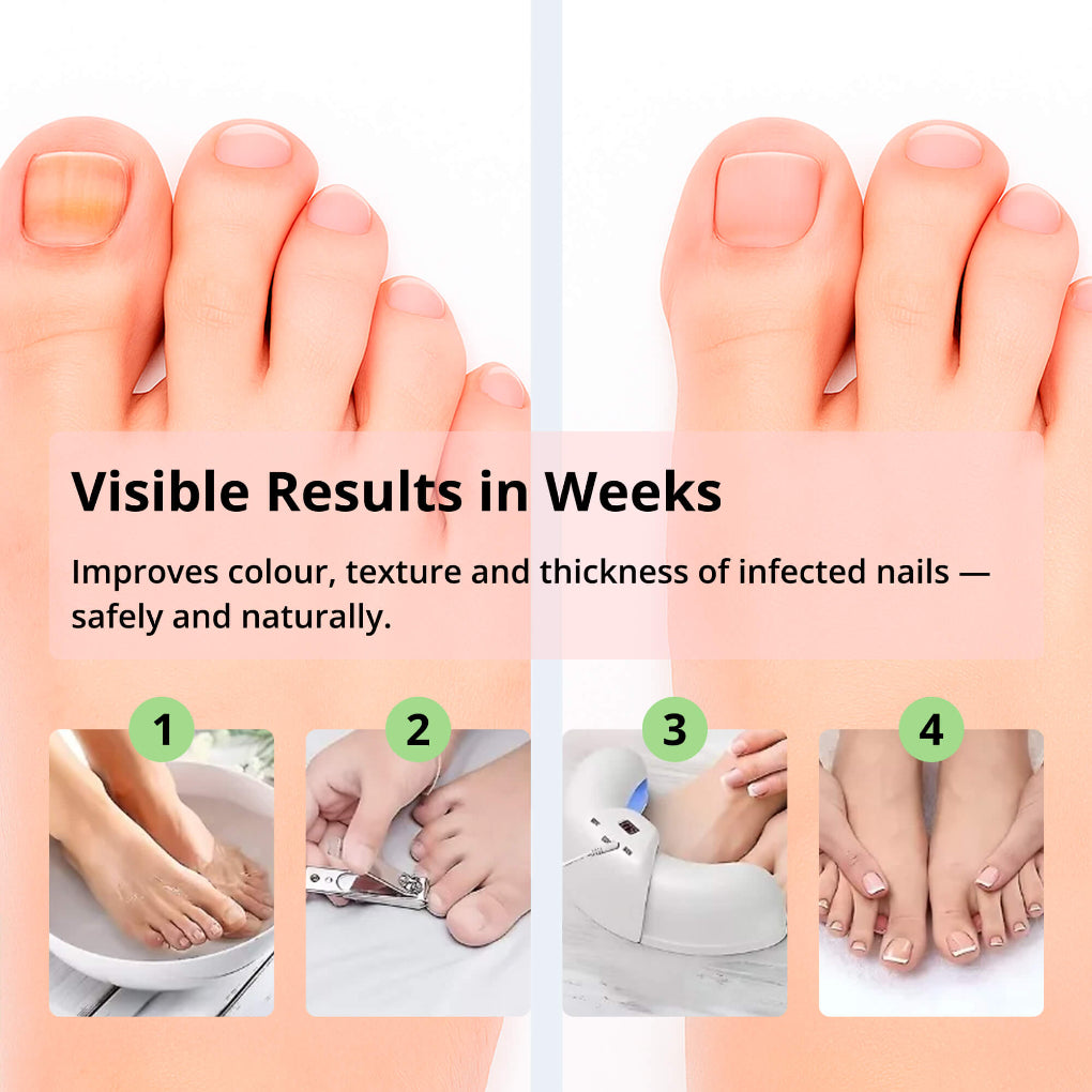 Advanced At Home Nail Fungus Treatment Device